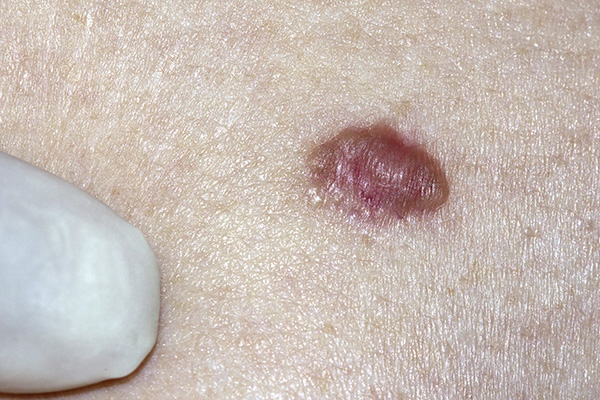 Basal cell carcinoma (BCC) skin cancer example