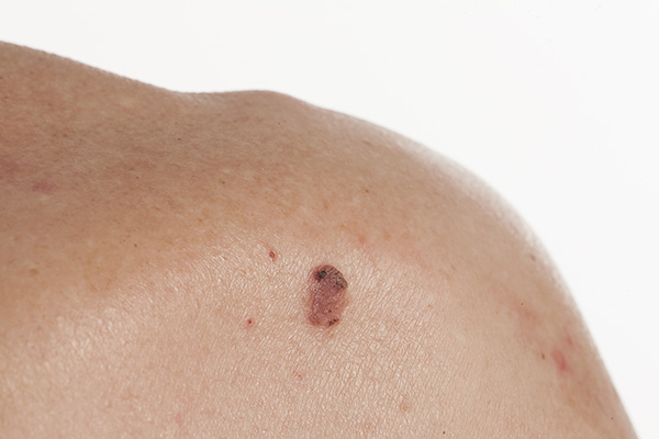 Squamous cell carcinoma (SCC) example