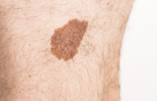 Melanoma example