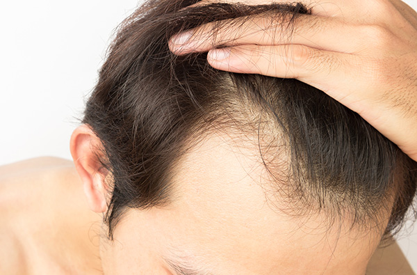 male pushing hair back showing beginning of hair loss