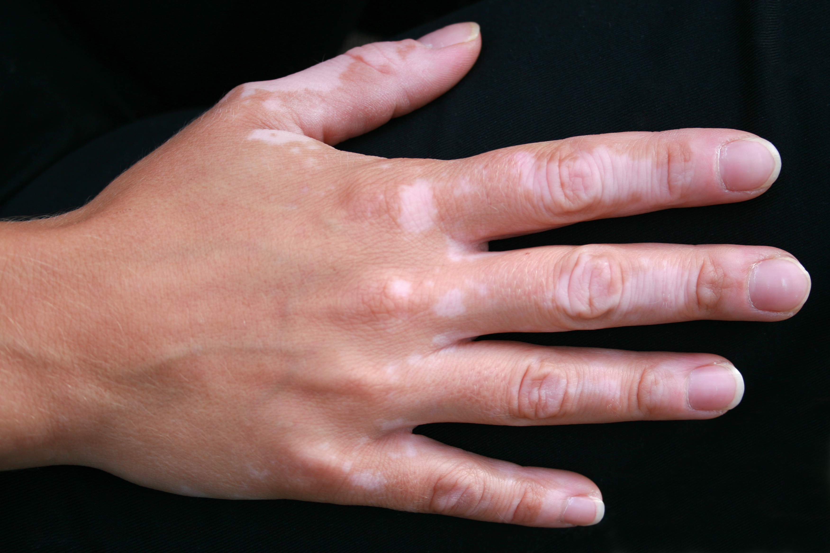 hand with with visible skin pigmentation differences