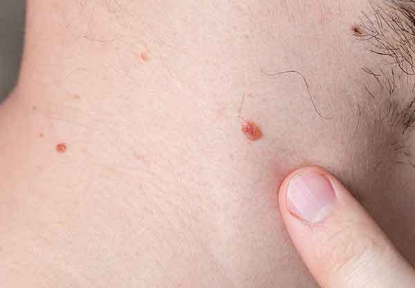 close up of mans neck with his finger pointing to a mole