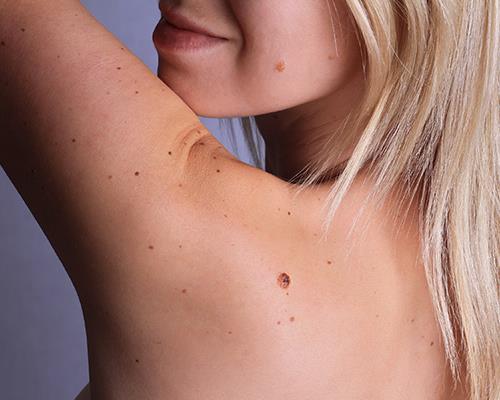 woman with long blonde hair smiling over shoulder showing bare back with some moles